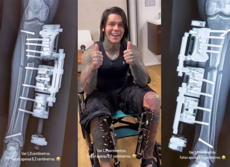 yefferson cossio|Colombian Influencer Undergoes Painful Surgery to Increase Height